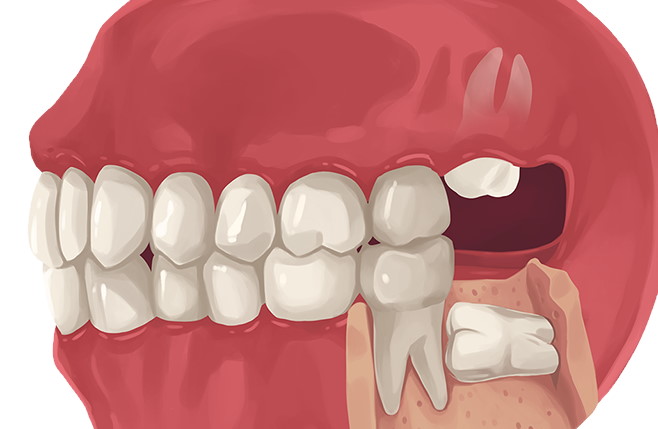 Wisdom Tooth Removal Surgery